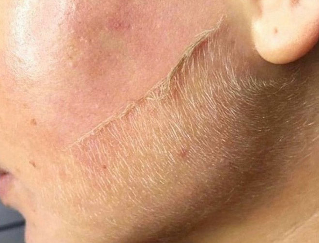 Wat is Dermaplaning en wat zijn de voordelen?